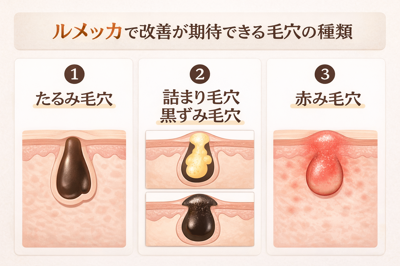 ルメッカで改善が期待できる毛穴の種類