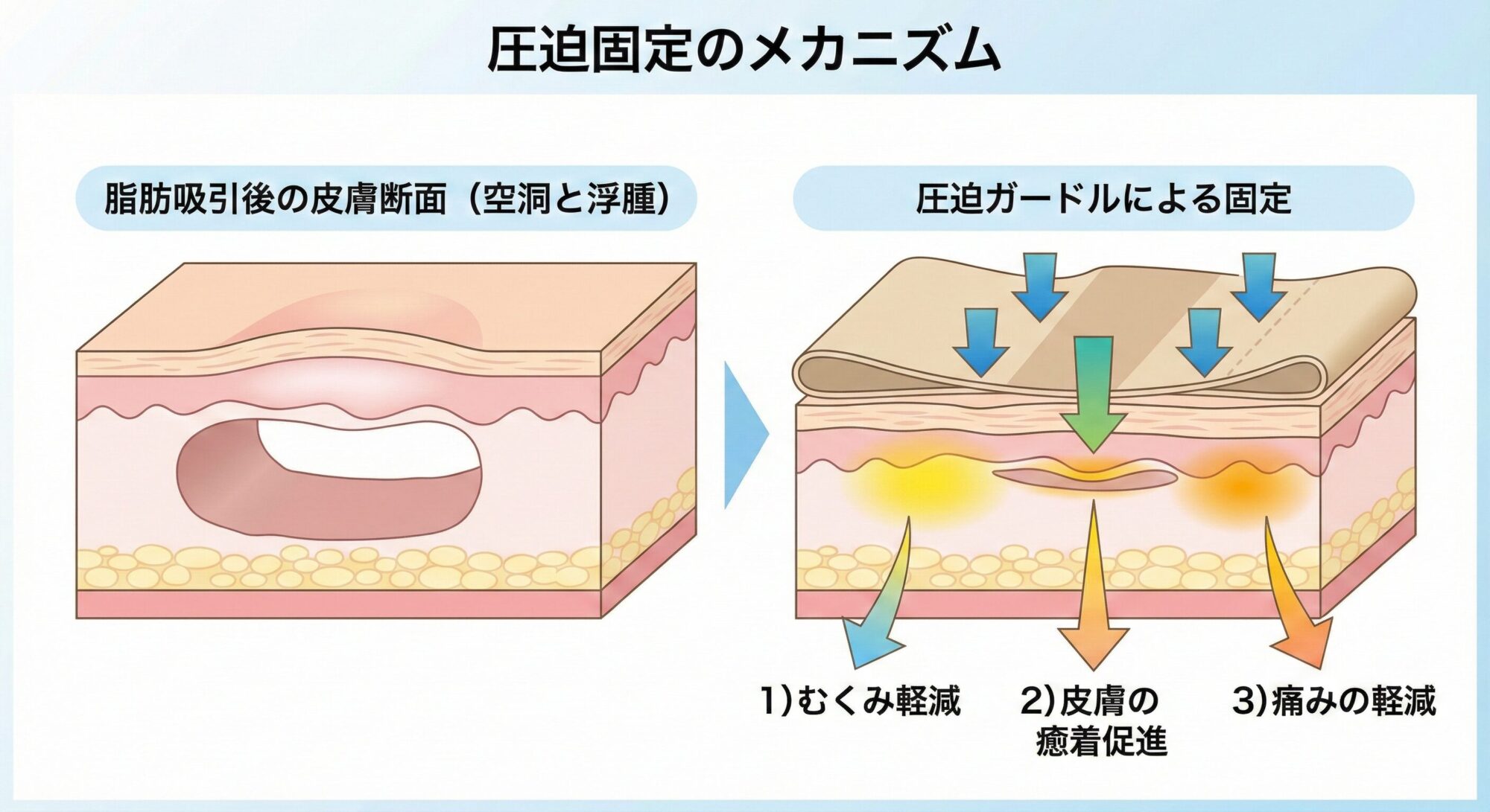 脂肪吸引の圧迫固定のメカニズム